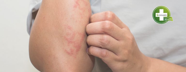 Cómo tratar el eczema atópico: ¿pueden ayudar los cosméticos de cáñamo?